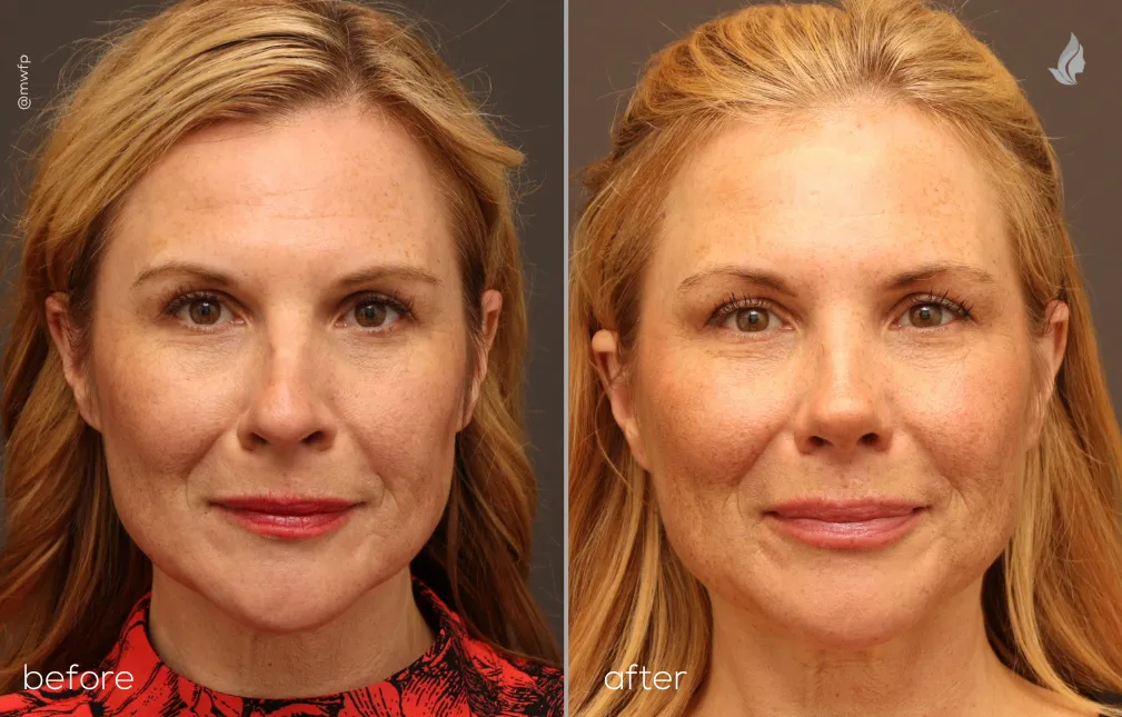 Front View rhinoplasty before and after photo by Dr. Bakeman