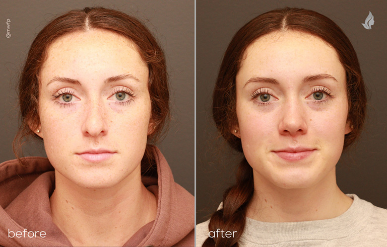 Front View rhinoplasty before and after photo by Dr. Bakeman