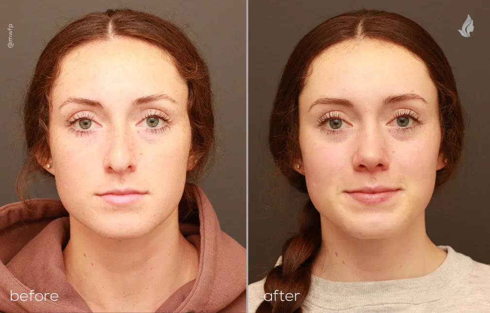 Front View rhinoplasty before and after photo by Dr. Bakeman
