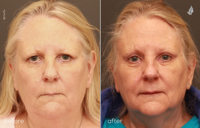 Front View upper bleph and temporal browlift before and after photo by Dr. Griffin