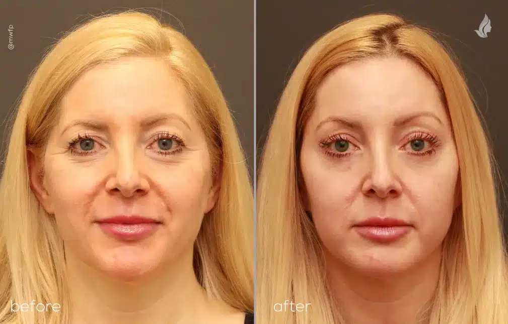 Front View upper blepharoplasty and endoscopic browlift before and after by Dr. Farhood
