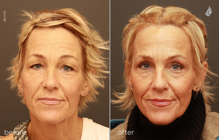 Front View upper blepharoplasty before and after by Dr. Griffin