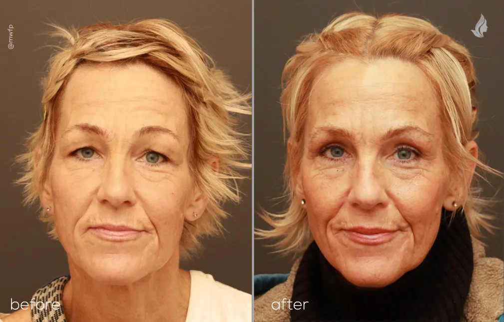 Front View upper blepharoplasty before and after by Dr. Griffin