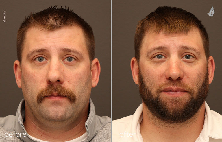 Front before after Rhinoplasty by Dr. Sciegienka