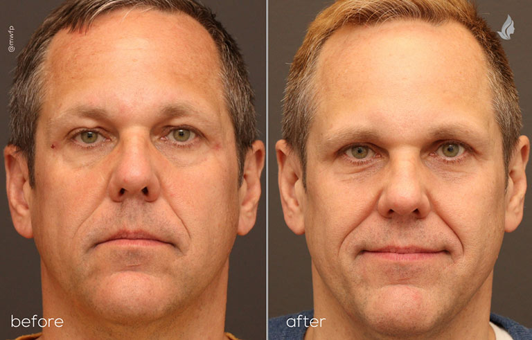 Front before and after Blepharoplasty by Dr Sciegienka