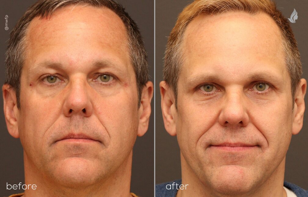 Front before and after Blepharoplasty by Dr. Sciegienka