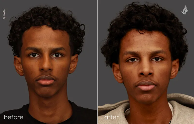 Front before and after Rhinoplasty Dr. Farhood