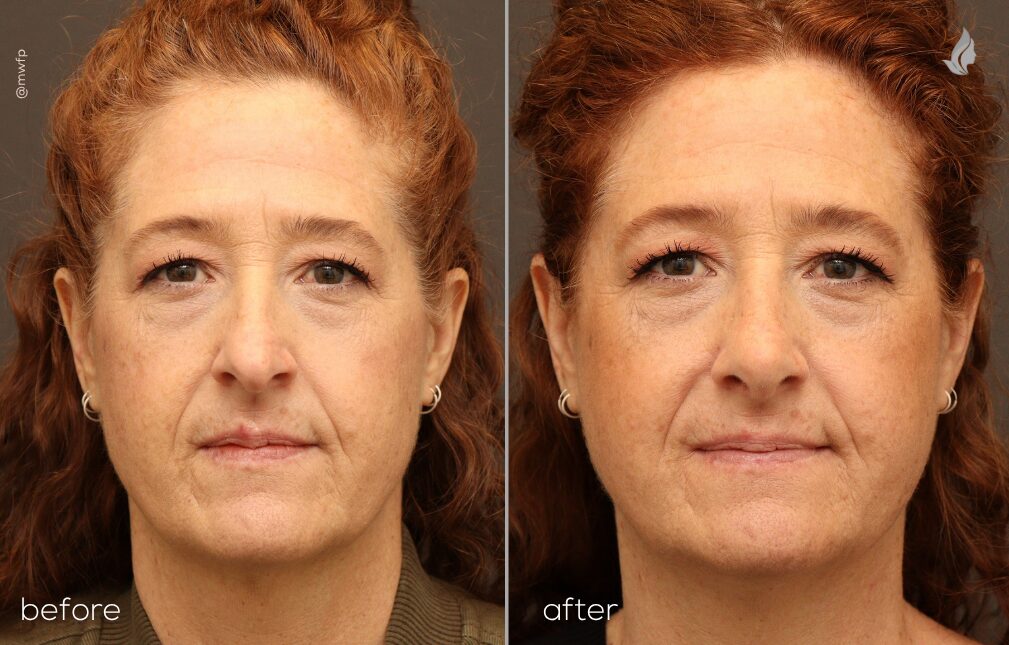 Front before and after Rhinoplasty by Dr. Sciegienka