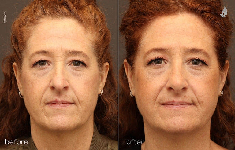 Front before and after by Dr Sciegienka