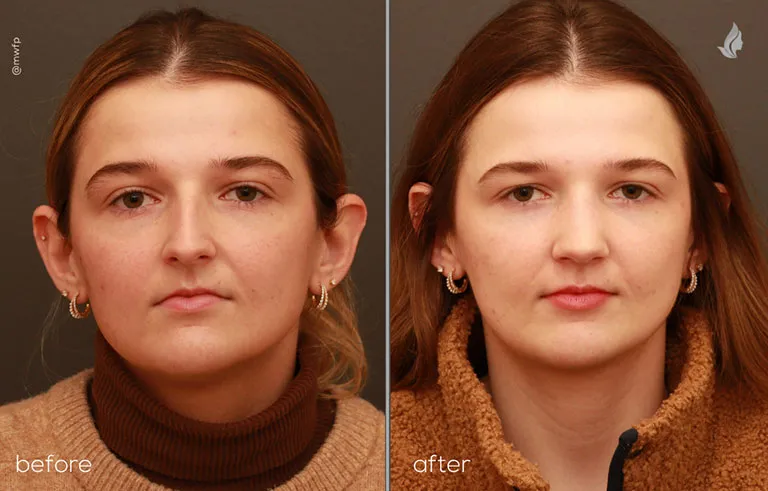Front before and after rhinoplasty by Dr. Bakeman