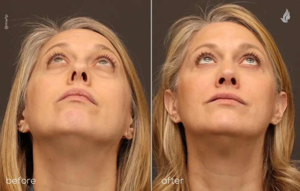 Front looking up View Blepharoplasty and Rhinoplasty before and after by Dr. Bakeman