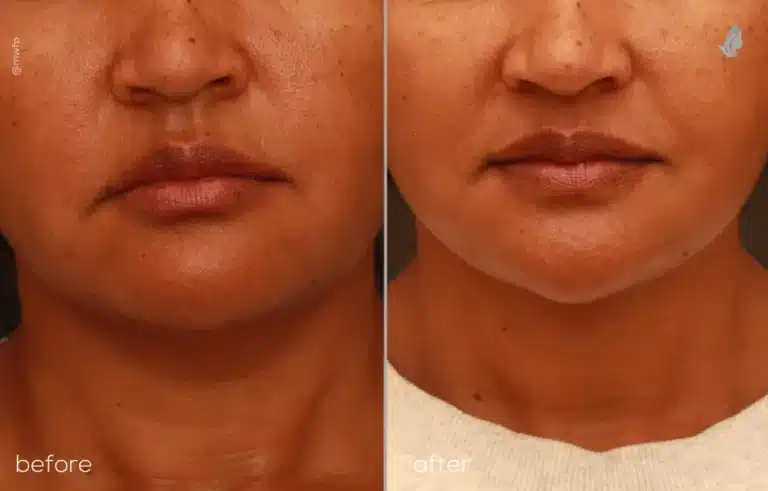 Front profile Deep plane face & neck lift and buccal fat removal