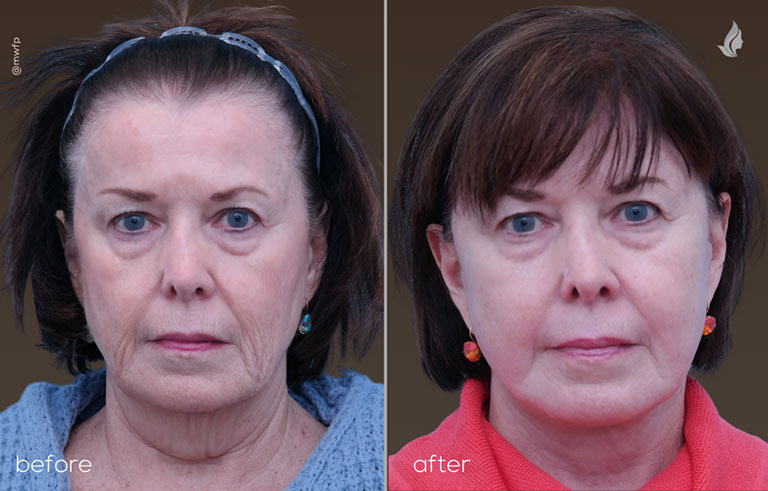 Front profile face neck lift along with CO resurfacing Tolan