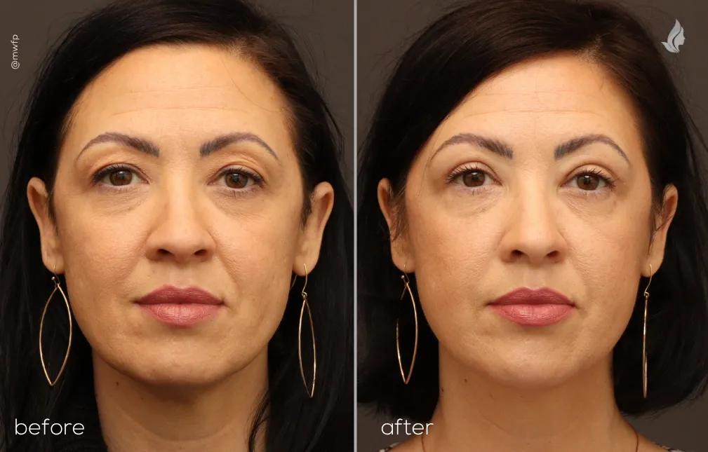 Front upper before and after blepharoplasty by Dr. Farhood