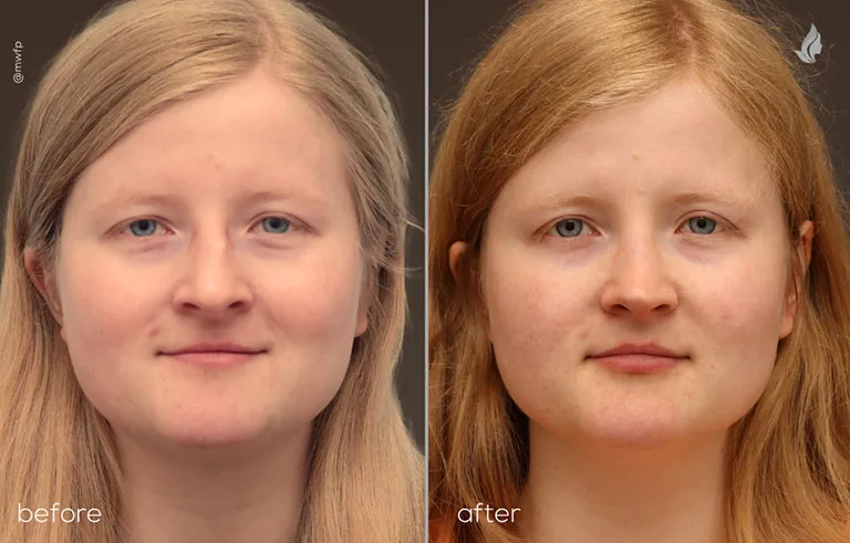 Frontal Rhinoplasty before and after by Dr. Tolan