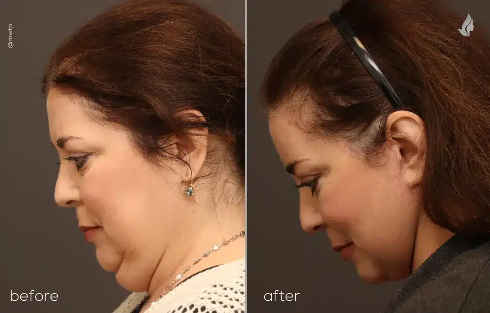 Left Chin Down View deep plane face lift and neck lift before and after by Dr. Farhood