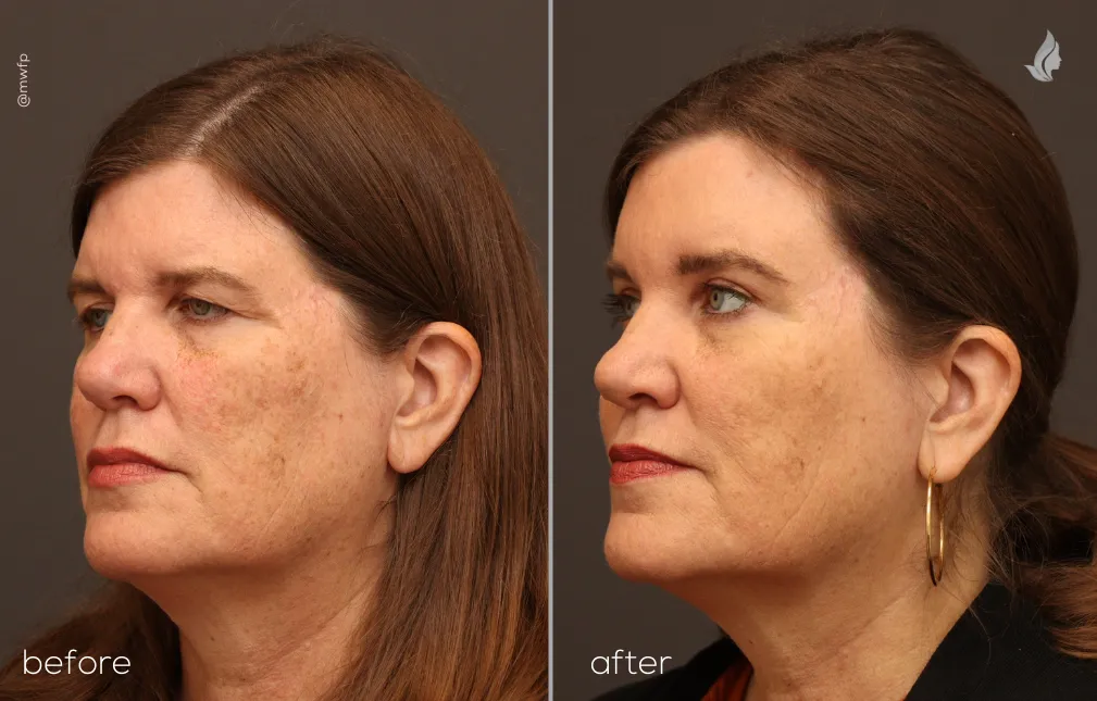 Left Oblique View Endobrow & Upper Blepharoplasty before and after by Dr. Farhood