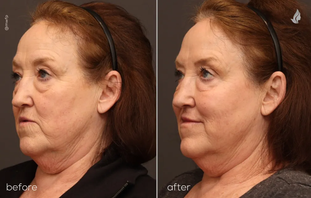 Left Oblique View Full Face Botox & Filler Refresh before and after by Angela V