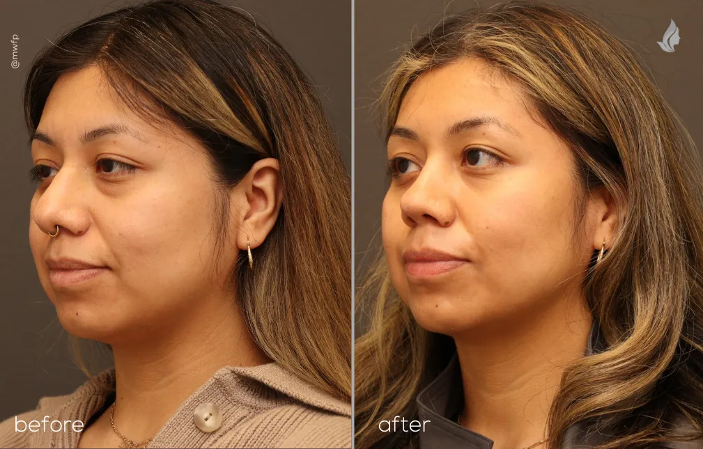 Left Oblique View before and after Rhinoplasty & Lower blepharoplasty by Dr. Farhood