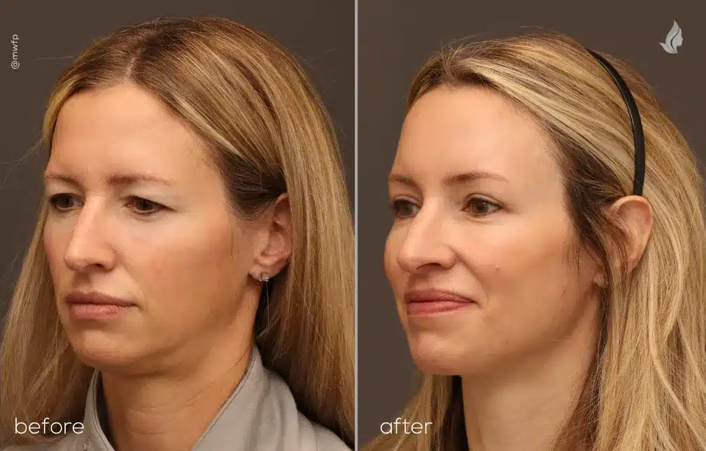 Left Oblique View endoscopic brow lift and upper blepharoplasty before and after photo by Dr. Bakeman