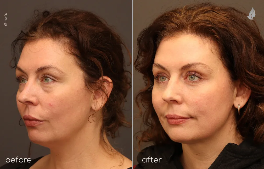 Left Oblique View lower blepharoplasty by Dr. Farhood