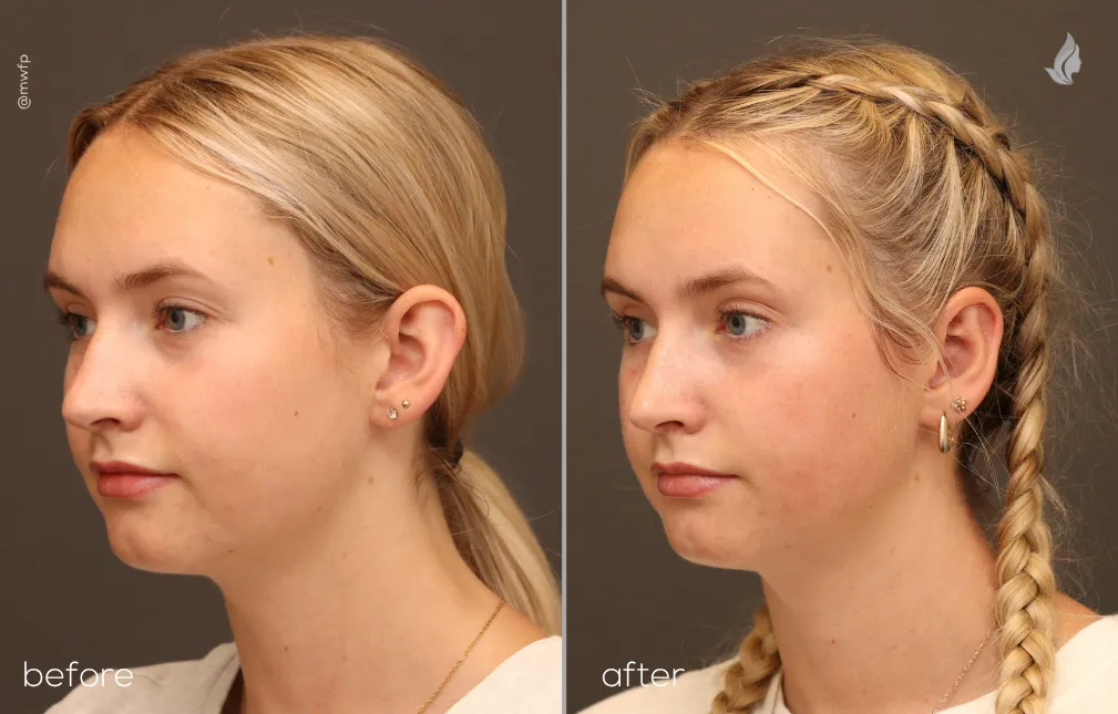 Left Oblique View otoplasty before and after photo by Dr. Bakeman