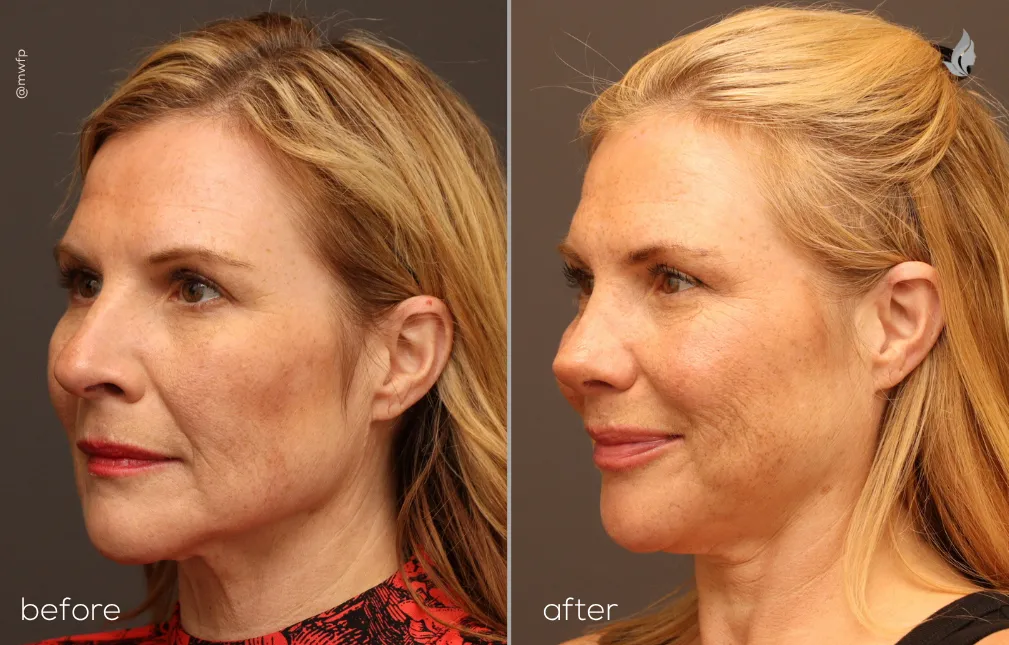 Left Oblique View rhinoplasty before and after photo by Dr. Bakeman