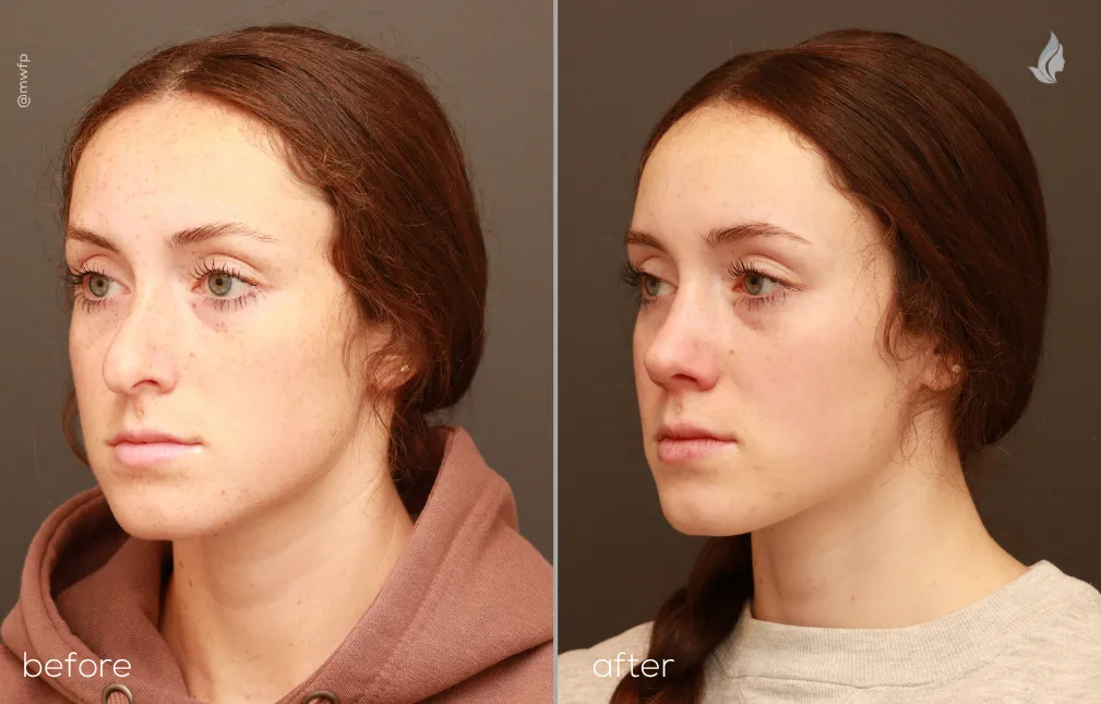 Left Oblique View rhinoplasty before and after photo by Dr. Bakeman