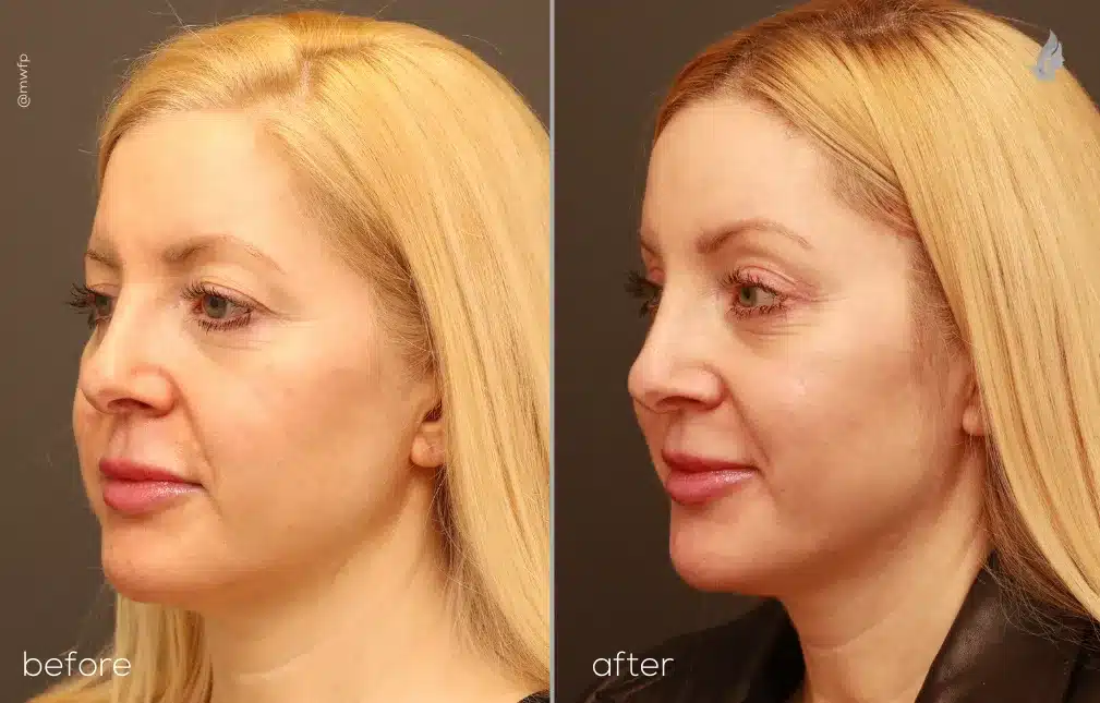 Left Oblique View upper blepharoplasty and endoscopic browlift before and after by Dr. Farhood