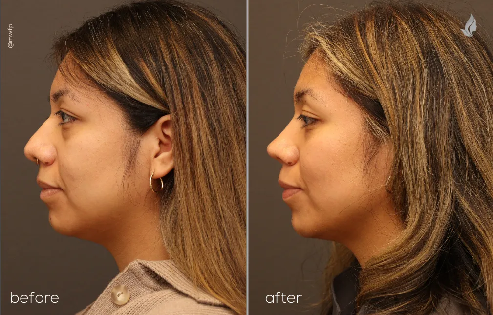 Left Profile View before and after Rhinoplasty & Lower blepharoplasty by Dr. Farhood