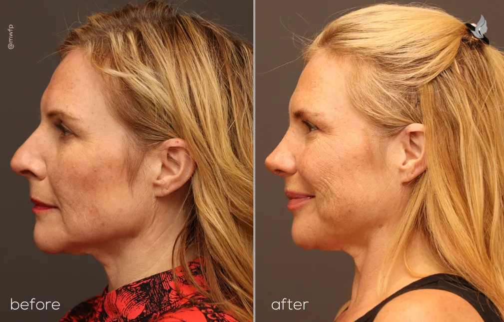 Left Profile View rhinoplasty before and after photo by Dr. Bakeman