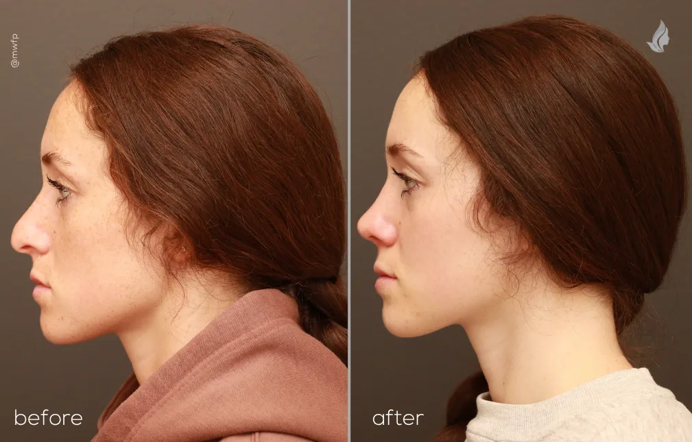 Left SIde View rhinoplasty before and after photo by Dr. Bakeman