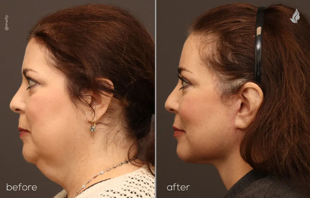 Left Side View deep plane face lift and neck lift before and after by Dr. Farhood