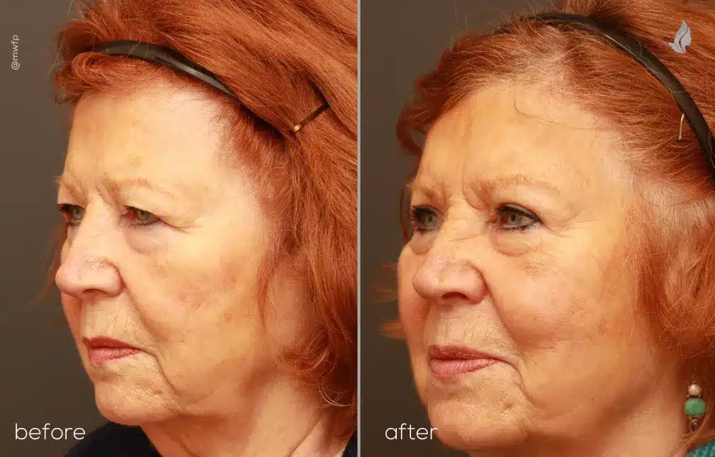 Left View Browlift & Upper Blepharoplasty by Dr. Griffin
