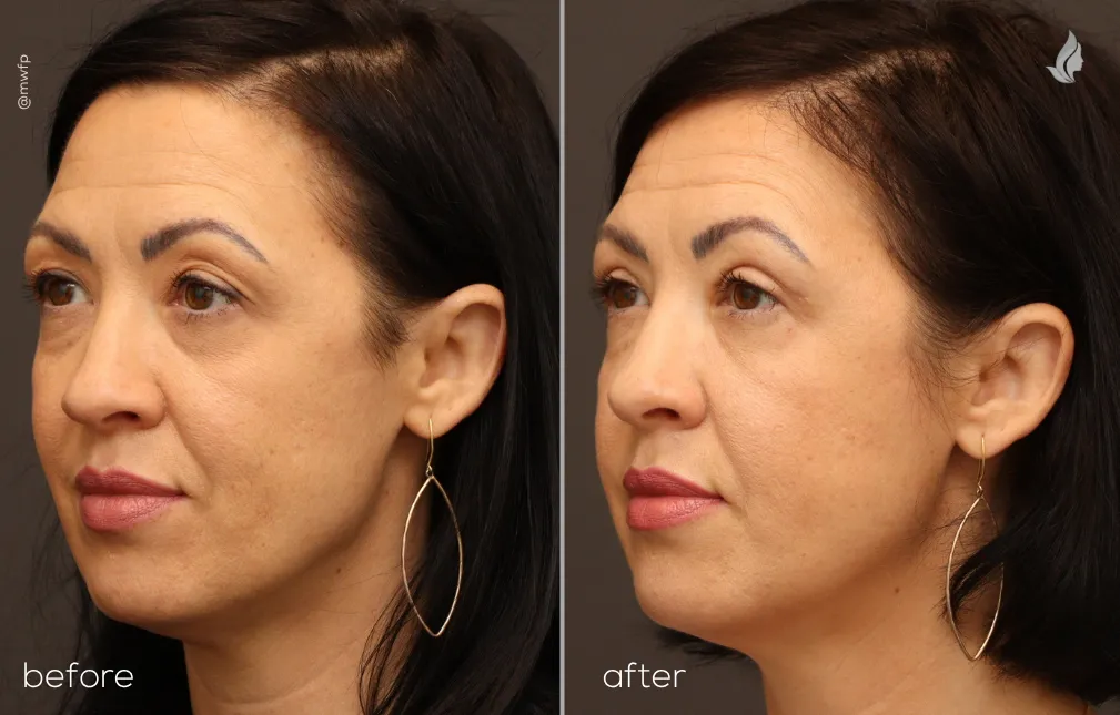 Oblique Left before and after upper blepharoplasty by Dr. Farhood