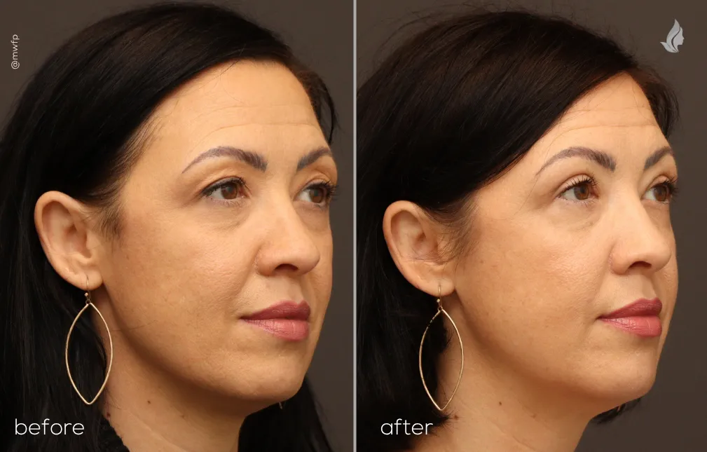 Oblique Right before and after upper blepharoplasty by Dr. Farhood