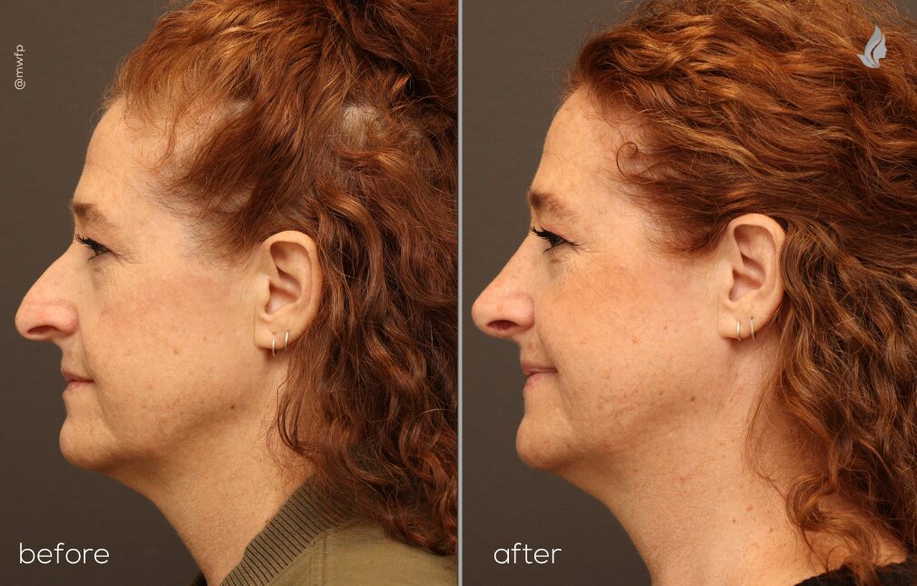 Profile Left before and after Rhinoplasty Dr. Sciegienka