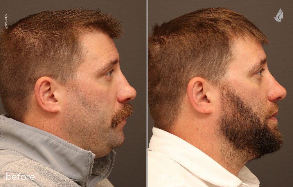 Profile Right before and after Rhinoplasty by Dr. Sciegienka