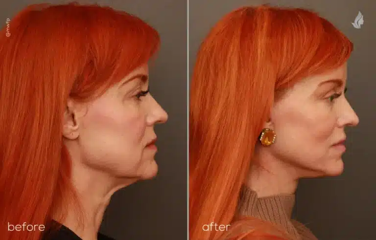 Profile Right before and after deep plane facelift by Dr. Bakeman