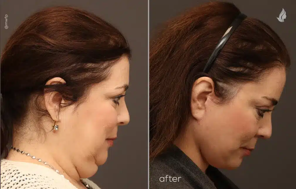 Right Chin Down View deep plane face lift and neck lift before and after by Dr. Farhood