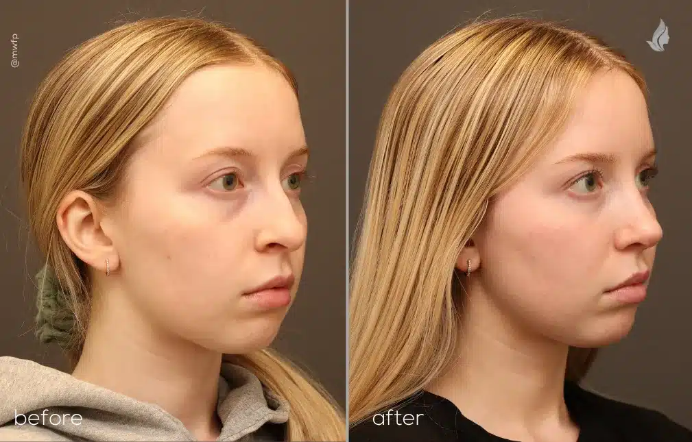 Right Oblique Front View autologous fat grafting & rhinoplasty before and after photo by Dr. Griffin