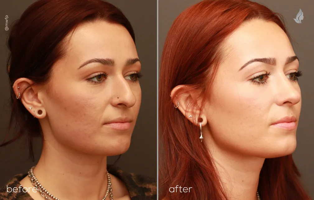 Right Oblique View Cosmetic and functional Rhinoplasty before and after by Dr. Griffin