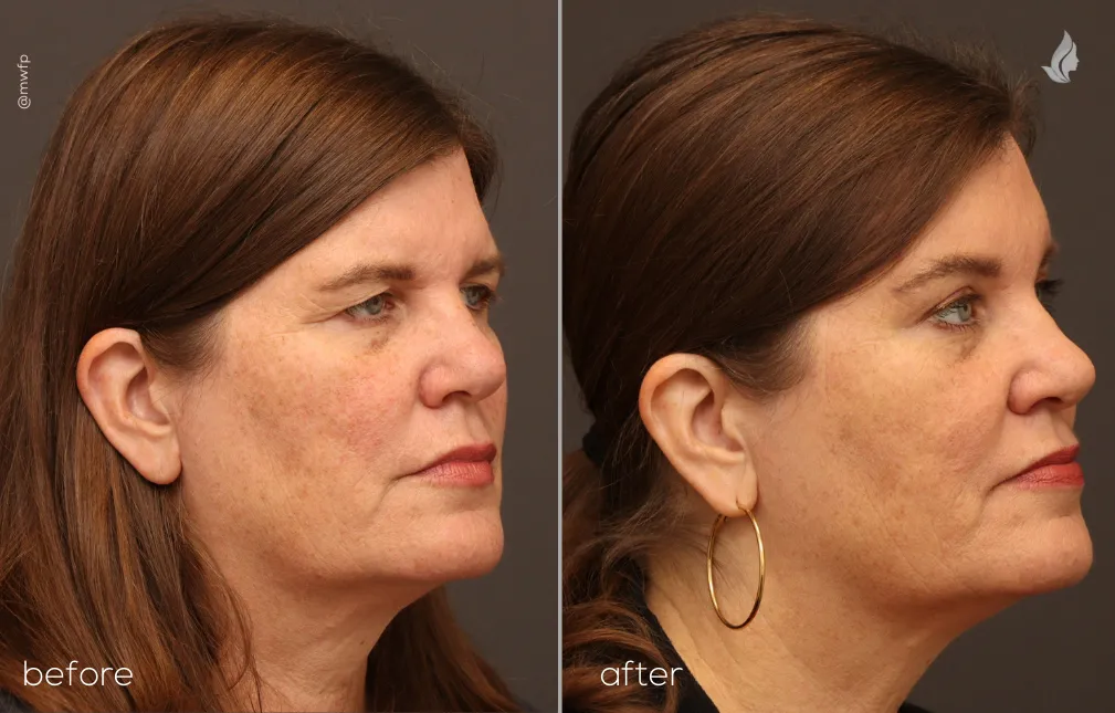 Right Oblique View Endobrow & Upper Blepharoplasty before and after by Dr. Farhood