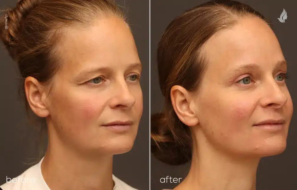 Right Oblique View Endoscopic Brow Lift & Upper Blepharoplasty before and after by Dr. Bakeman