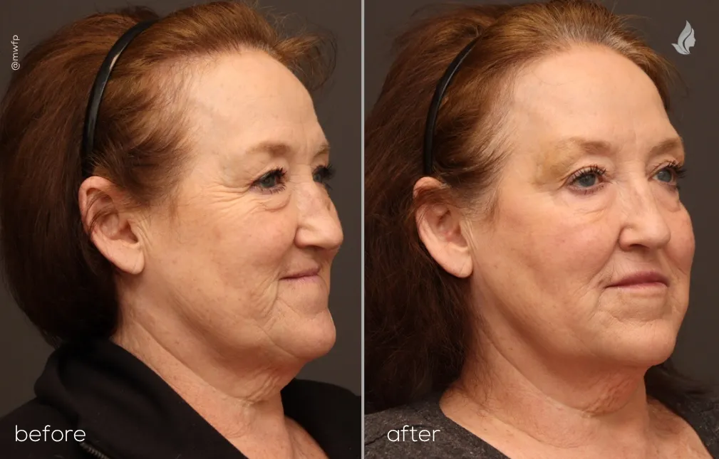 Right Oblique View Full Face Botox & Filler Refresh before and after by Angela V