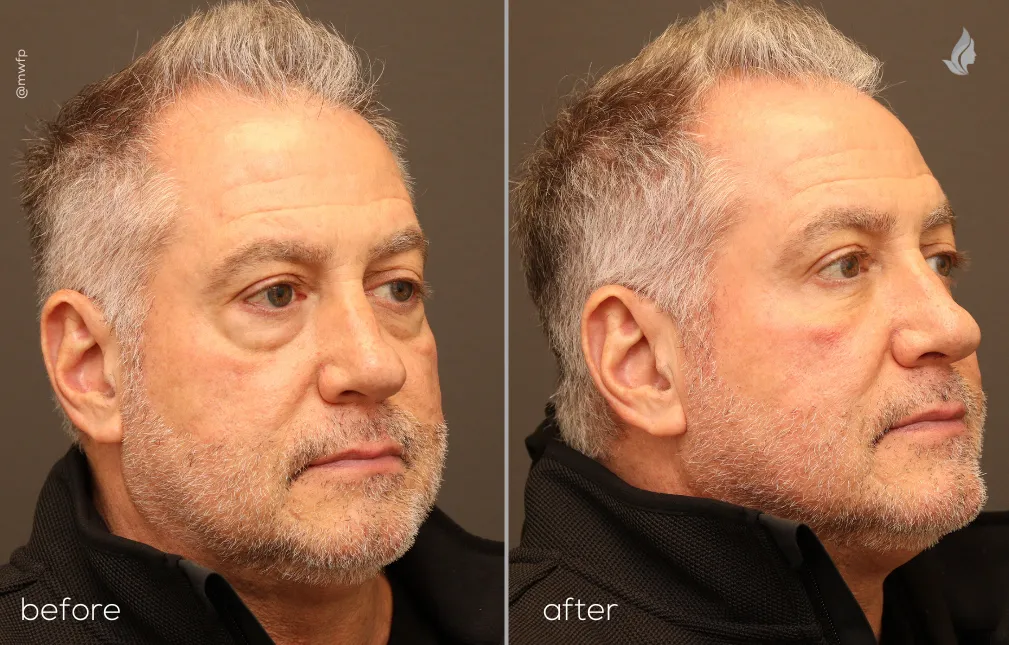 Right Oblique View Lower Blepharoplasty by Dr. Farhood