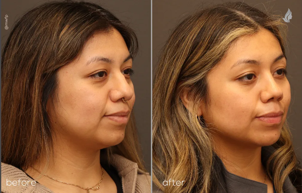Right Oblique View before and after Rhinoplasty & Lower blepharoplasty by Dr. Farhood