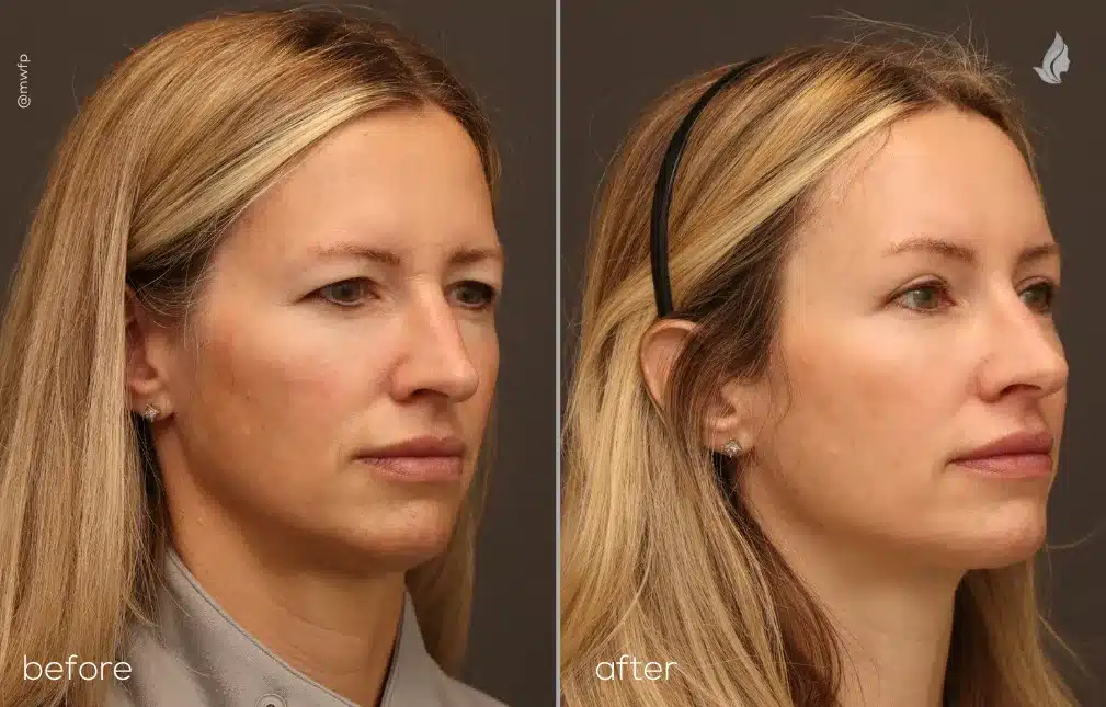Right Oblique View endoscopic brow lift and upper blepharoplasty before and after photo by Dr. Bakeman