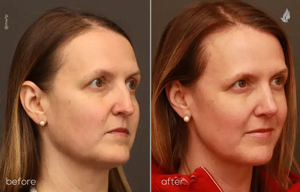 Right Oblique View rhinoplasty before and after by Dr. Griffin