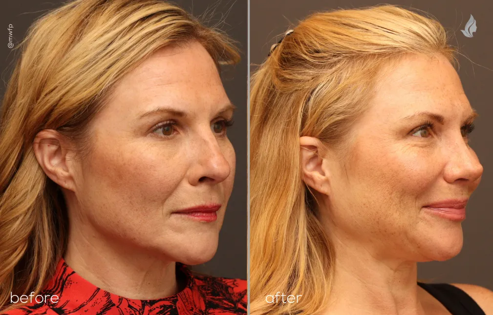 Right Oblique View rhinoplasty before and after photo by Dr. Bakeman